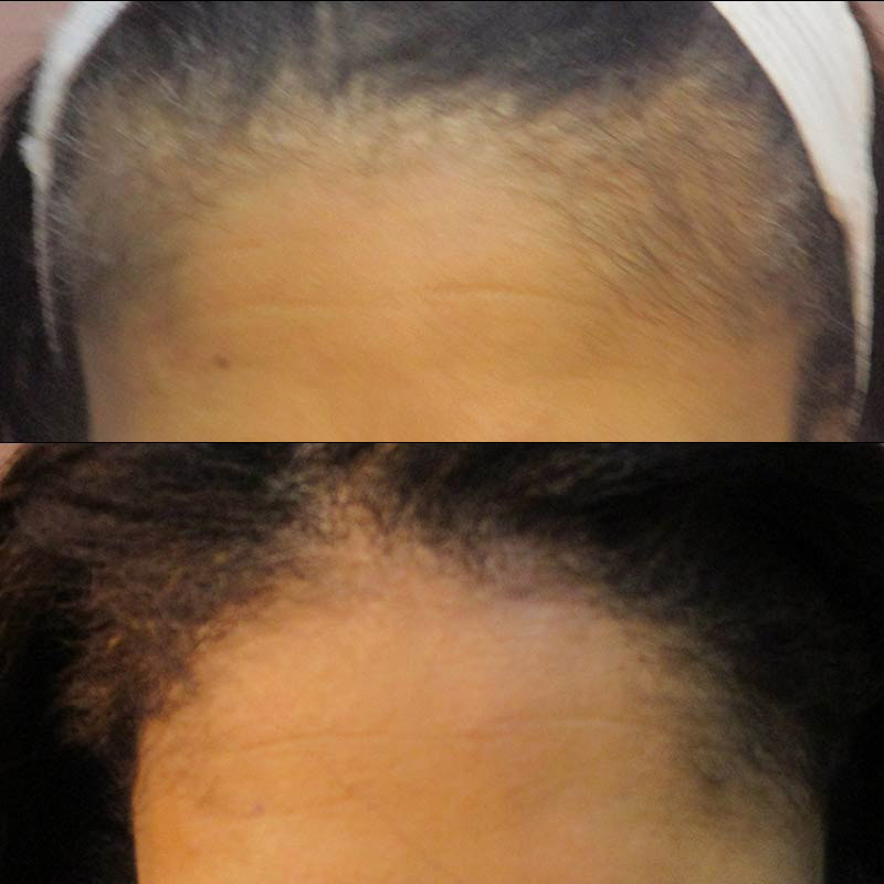 PRP Hair Loss Case #1